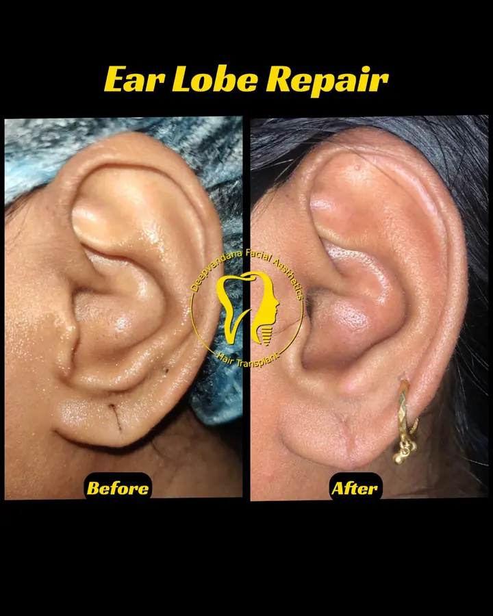Earlobe repair — before and after