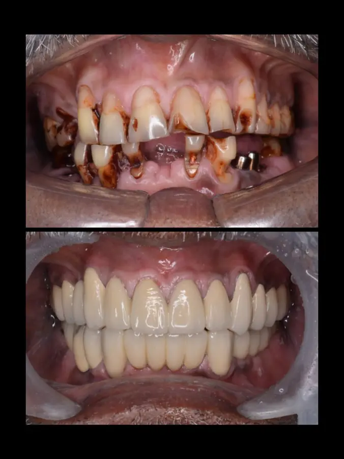 Full-mouth crowns case 1
