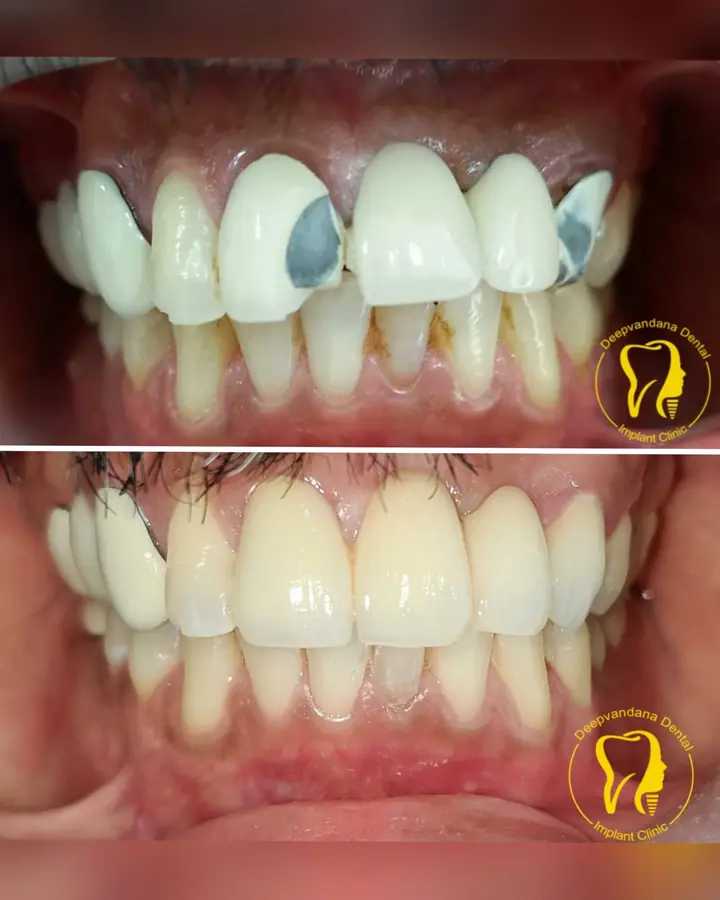 Smile makeover case 9