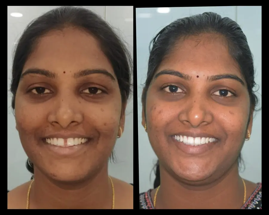 Smile makeover case 11